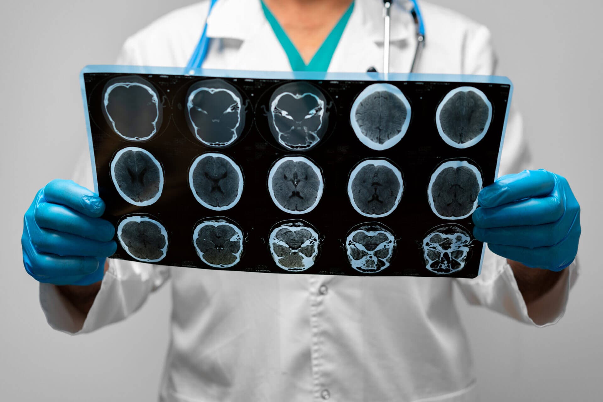 Stroke: Causes, Symptoms, Diagnosis & Treatment in Jabalpur, Madhya Pradesh